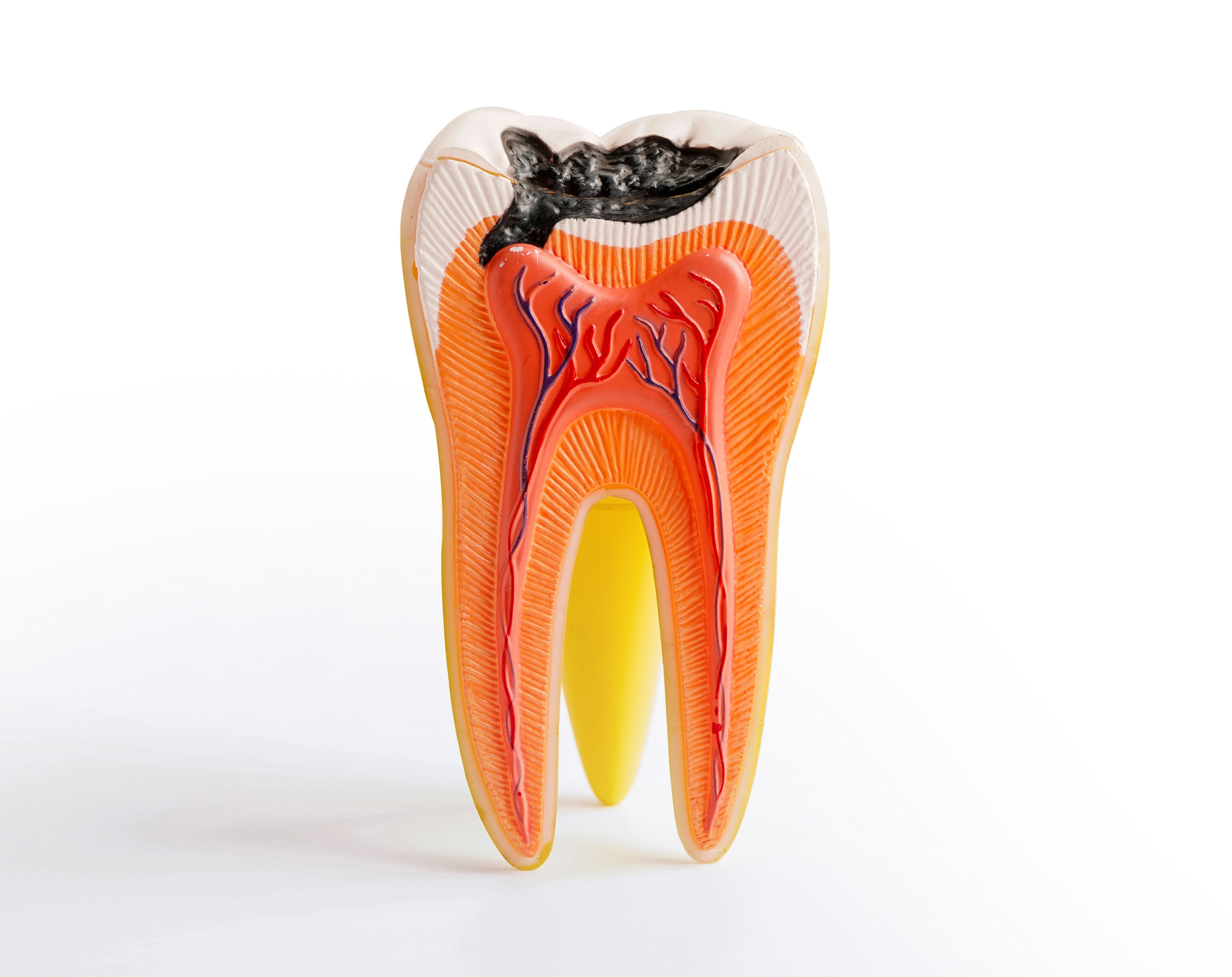 A detailed image of the inside of a tooth that has a cavity.