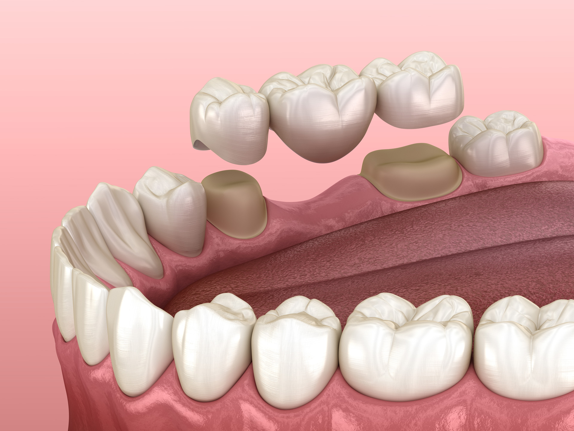 A dental implant featuring a crown and tooth, illustrating the concept of dental bridges for tooth replacement.