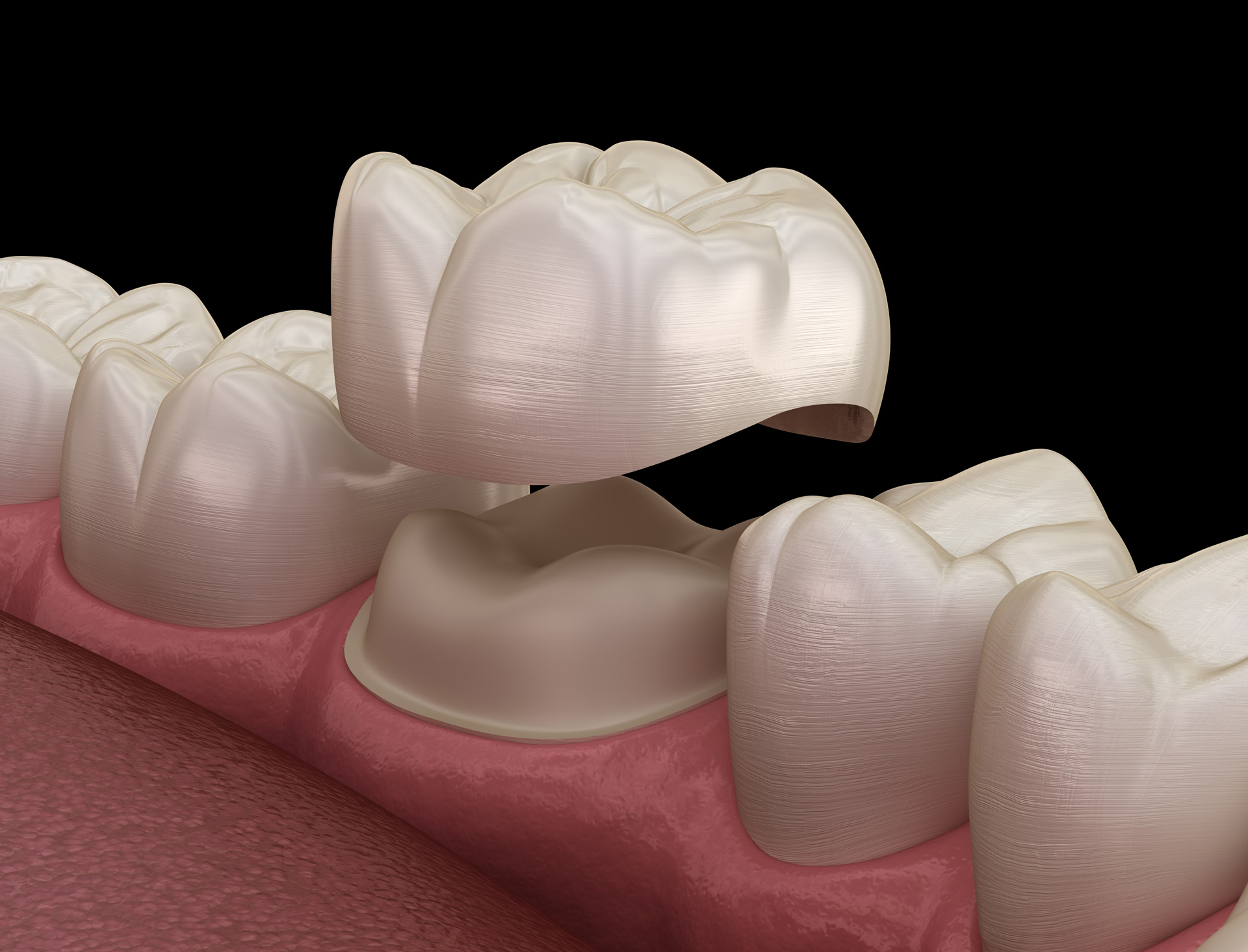 A dental crown being placed over a prepared tooth