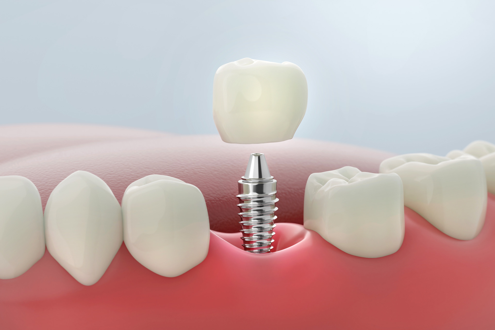 A dental implant with a metal post and a crown being placed