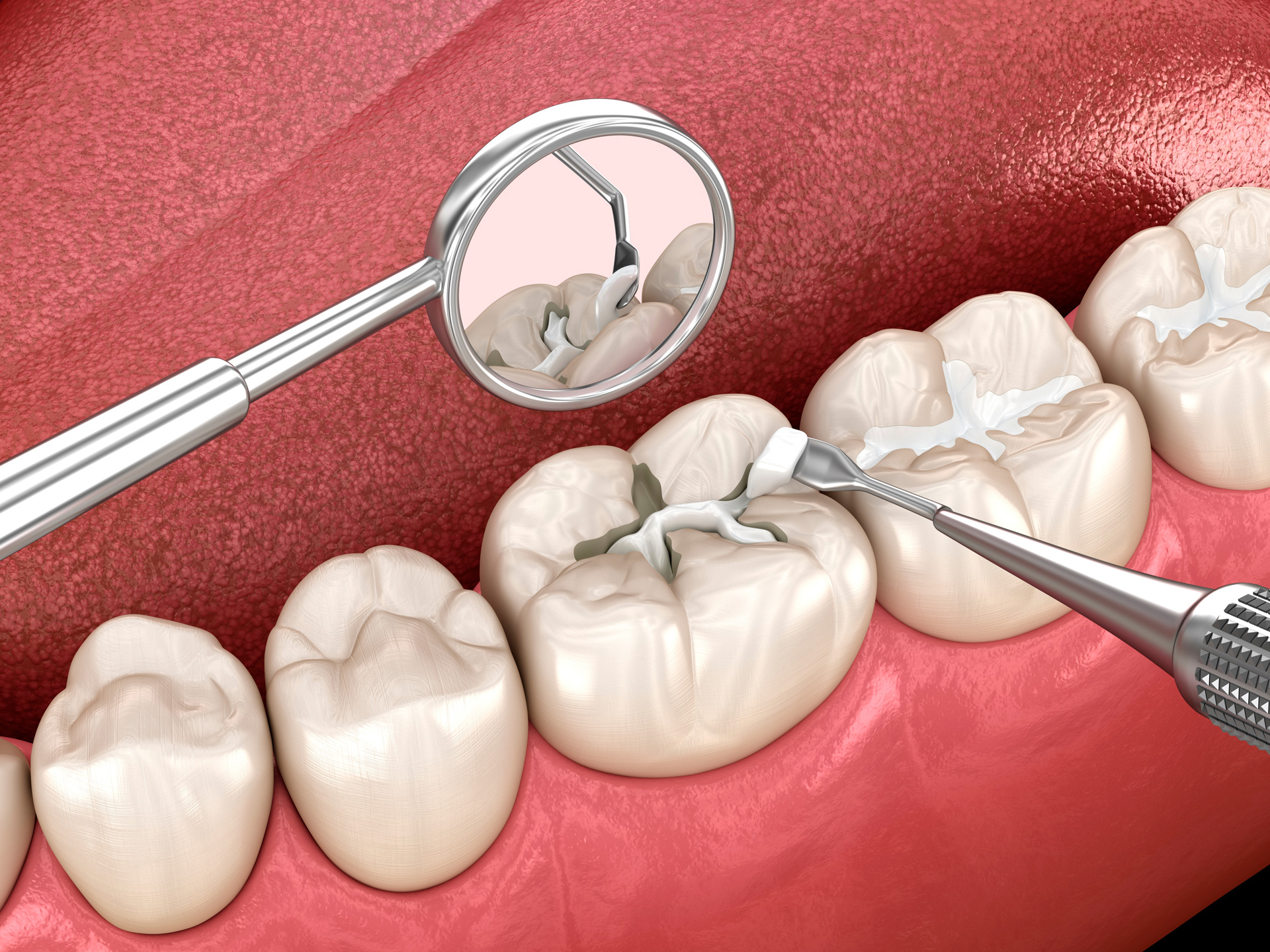 A dental technician applying dental sealants to a tooth.