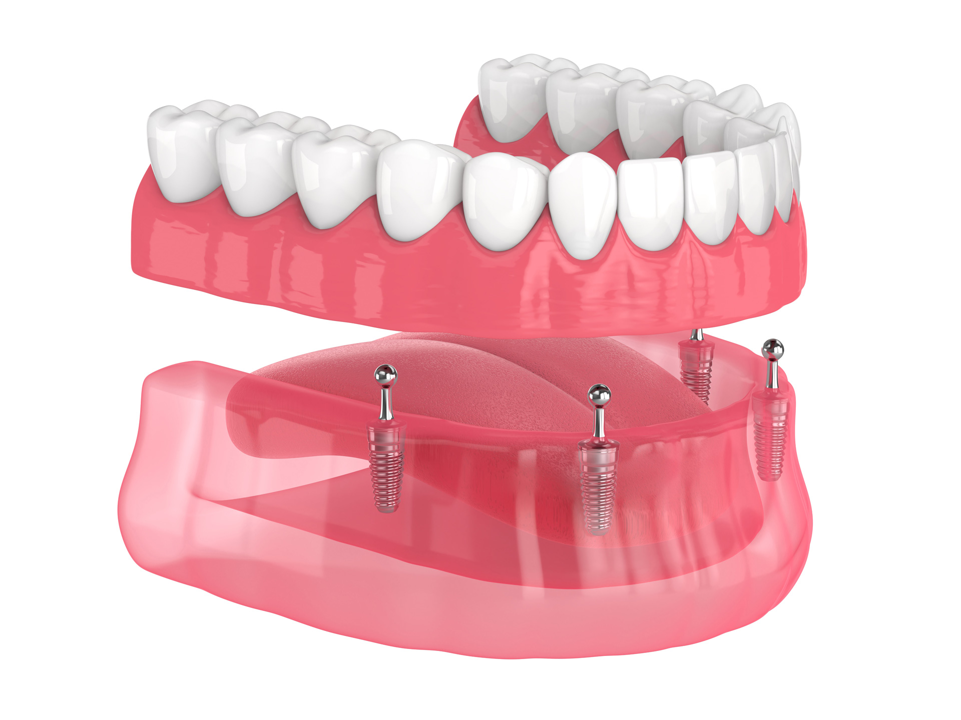 All-on-4 implant system with a full arch of teeth supported by four implants