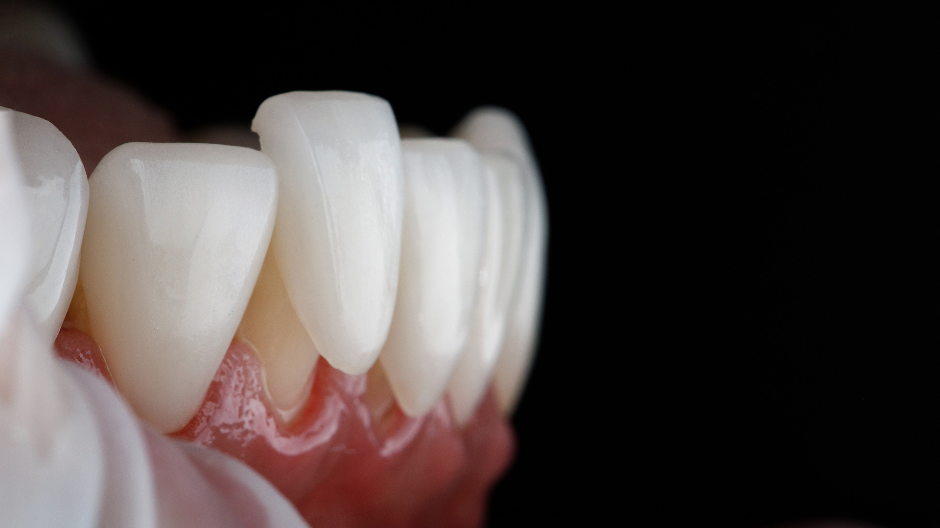 Detailed view of a tooth showcasing the integration of veneers.